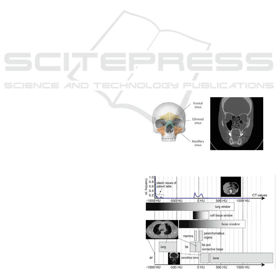 Visualization 3d Reconstruction Volume Rendering Of Mucus Into Paranasal Sinuses Rodrigo Freitas Lima And Mauricio Marengoni Postgraduate Programme In Electrical Engeneering Mackenzie Presbyterian University Sao Paulo Brazil Keywords